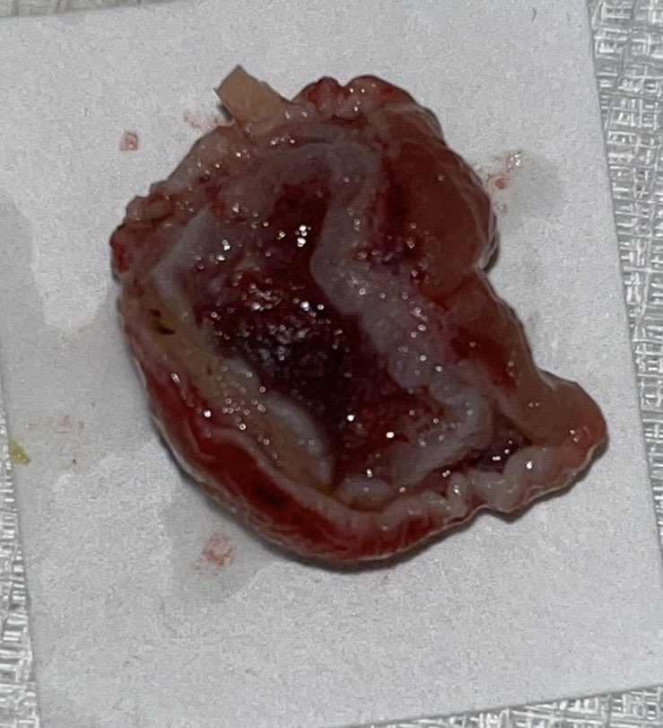 Sergio Coda MD PhD (@sergiocoda3) on Twitter photo Colonic Endoscopic Full Thickness Resection week <a href="/BhrutE/">BHRUT Endoscopy NHS ๐</a> <a href="/DivNhs/">Surgery Anaesthesia Critical Care Group BHR NHS ๐</a> <a href="/BHRUT_NHS/">BHRUT NHS ๐ฅ</a>
81y old comorbid patient unfit for surgery
20mm sigmoid colon malignant (histology proven) polyp
No complications, patient discharged on the same day.
<a href="/Allison21100650/">Allison Wood</a> <a href="/sasbanerjee/">Sas Banerjee</a> <a href="/dramalesh/">๐ ๐ธ๐๐๐๐๐ค๐</a> <a href="/SynMedUK/">SynMed</a> Colonic Endoscopic Full Thickness Resection week <a href="/BhrutE/">BHRUT Endoscopy NHS ๐</a> <a href="/DivNhs/">Surgery Anaesthesia Critical Care Group BHR NHS ๐</a> <a href="/BHRUT_NHS/">BHRUT NHS ๐ฅ</a>
81y old comorbid patient unfit for surgery
20mm sigmoid colon malignant (histology proven) polyp
No complications, patient discharged on the same day.
<a href="/Allison21100650/">Allison Wood</a> <a href="/sasbanerjee/">Sas Banerjee</a> <a href="/dramalesh/">๐ ๐ธ๐๐๐๐๐ค๐</a> <a href="/SynMedUK/">SynMed</a>