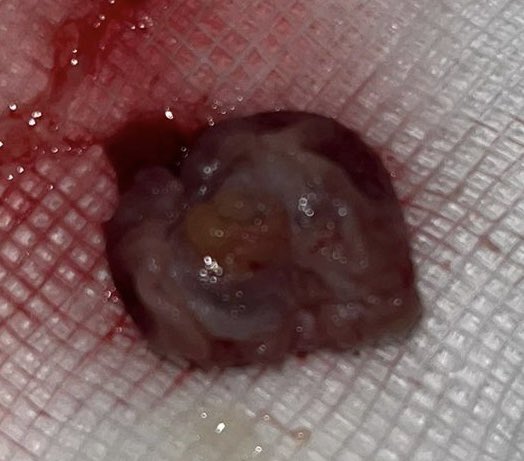 Sergio Coda MD PhD (@sergiocoda3) on Twitter photo Colonic Endoscopic Full Thickness Resection week <a href="/BhrutE/">BHRUT Endoscopy NHS ๐</a> <a href="/DivNhs/">Surgery Anaesthesia Critical Care Group BHR NHS ๐</a> <a href="/BHRUT_NHS/">BHRUT NHS ๐ฅ</a>
89y old comorbid patient unfit for surgery.
25mm hepatic flexure malignant (histology proven) polyp
No complications, patient discharged the same day.
<a href="/Allison21100650/">Allison Wood</a> <a href="/sasbanerjee/">Sas Banerjee</a> <a href="/dramalesh/">๐ ๐ธ๐๐๐๐๐ค๐</a> <a href="/SynMedUK/">SynMed</a> Colonic Endoscopic Full Thickness Resection week <a href="/BhrutE/">BHRUT Endoscopy NHS ๐</a> <a href="/DivNhs/">Surgery Anaesthesia Critical Care Group BHR NHS ๐</a> <a href="/BHRUT_NHS/">BHRUT NHS ๐ฅ</a>
89y old comorbid patient unfit for surgery.
25mm hepatic flexure malignant (histology proven) polyp
No complications, patient discharged the same day.
<a href="/Allison21100650/">Allison Wood</a> <a href="/sasbanerjee/">Sas Banerjee</a> <a href="/dramalesh/">๐ ๐ธ๐๐๐๐๐ค๐</a> <a href="/SynMedUK/">SynMed</a>