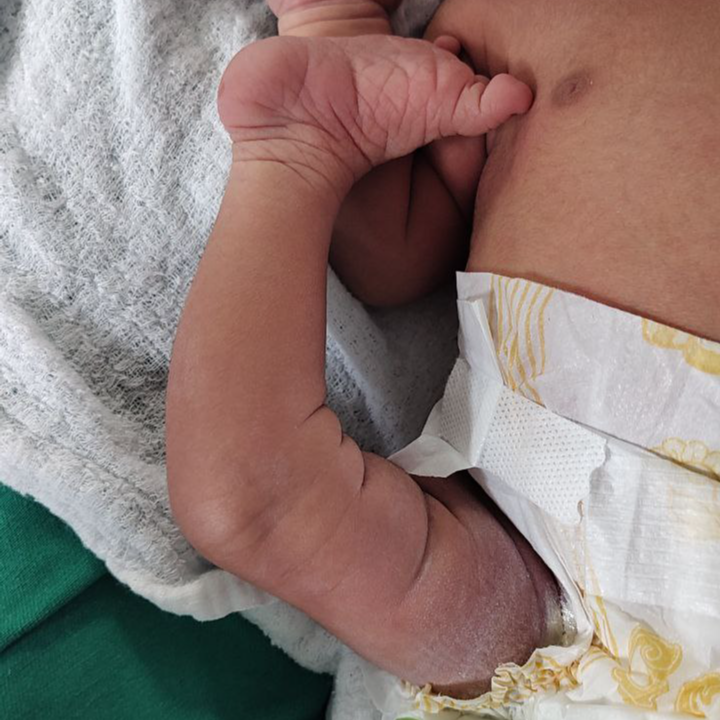 Leonardo Lustosa 𦴠(@drleolustosa) on Twitter photo π― Congenital dislocation of the knee
π― CDK is often associated with syndromes, DDH, and clubfoot
π― Although the presentation may be shocking to the parents, treatment is usually non-surgical
π Further reading <a href="/Radiopaedia/">Radiopaedia.org</a>: radiopaedia.org/articles/203673
#orthotwitter #RadRes π― Congenital dislocation of the knee
π― CDK is often associated with syndromes, DDH, and clubfoot
π― Although the presentation may be shocking to the parents, treatment is usually non-surgical
π Further reading <a href="/Radiopaedia/">Radiopaedia.org</a>: radiopaedia.org/articles/203673
#orthotwitter #RadRes