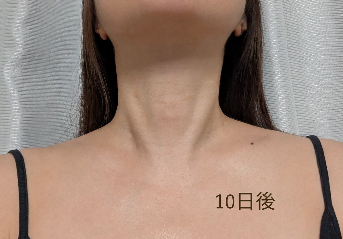 年始にソウルのドクターエバーズ江南店でレーザーリフト、水光注射、首フィラーしてきました。
首フィラーはベロテロ1cc&amp;リフテラ2000ショットx2。
昨年別クリニックで首にリジュラン打ったのは全く効果なかったですが、今回はドクターが丁寧に打ってくれて大満足♪続く