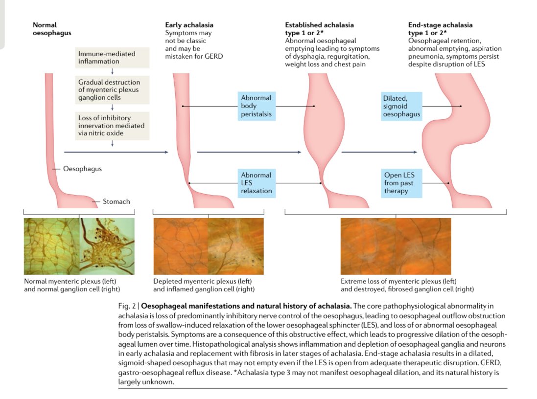 Sociedad Española de Patología Digestiva (SEPD) (@sepdigestiva) on Twitter photo Historia Natural de Acalasia 🙋🏻♂️
vía <a href="/NatRevGastroHep/">Nature Reviews Gastroenterology & Hepatology</a>
nature.com/articles/s4157… Historia Natural de Acalasia 🙋🏻♂️
vía <a href="/NatRevGastroHep/">Nature Reviews Gastroenterology & Hepatology</a>
nature.com/articles/s4157…
