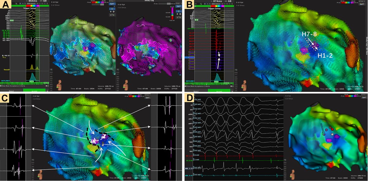In biopsy-proven #myocarditis pts, VT ablation ⬇️ #arrhythmia recurrences. Acute stage of myocarditis was associated with less favorable outcomes jacc.org/doi/10.1016/j.…

Editorial comment by <a href="/MurataHiroshige/">Hiro</a>: jacc.org/doi/10.1016/j.…

#JACCAsia #Epeeps #ablateVT