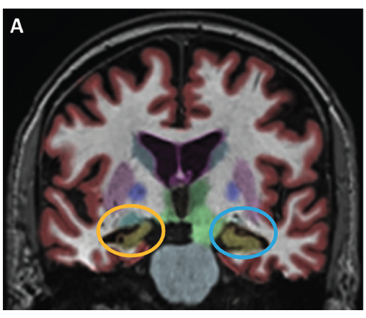 1/
A 78 yo W is seen for 5 years of gradual short-term memory difficulties such as remembering to take her medicine, names, and poor recall of new facts. It seems her deficits are getting worse.

This is Alzheimer Disease, right?

Or… are you LATE in considering a different dx?