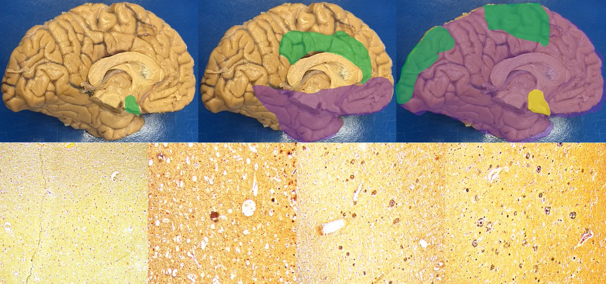 Brain (@brain1878) on Twitter photo In a postmortem analysis of more than 10,000 people with dementia, Zawar et al. show that those with ongoing seizures in the year prior to death died at a younger age and had more severe neurodegeneration and neuropathology linked to Alzheimer's disease. tinyurl.com/3kcrdafn In a postmortem analysis of more than 10,000 people with dementia, Zawar et al. show that those with ongoing seizures in the year prior to death died at a younger age and had more severe neurodegeneration and neuropathology linked to Alzheimer's disease. tinyurl.com/3kcrdafn