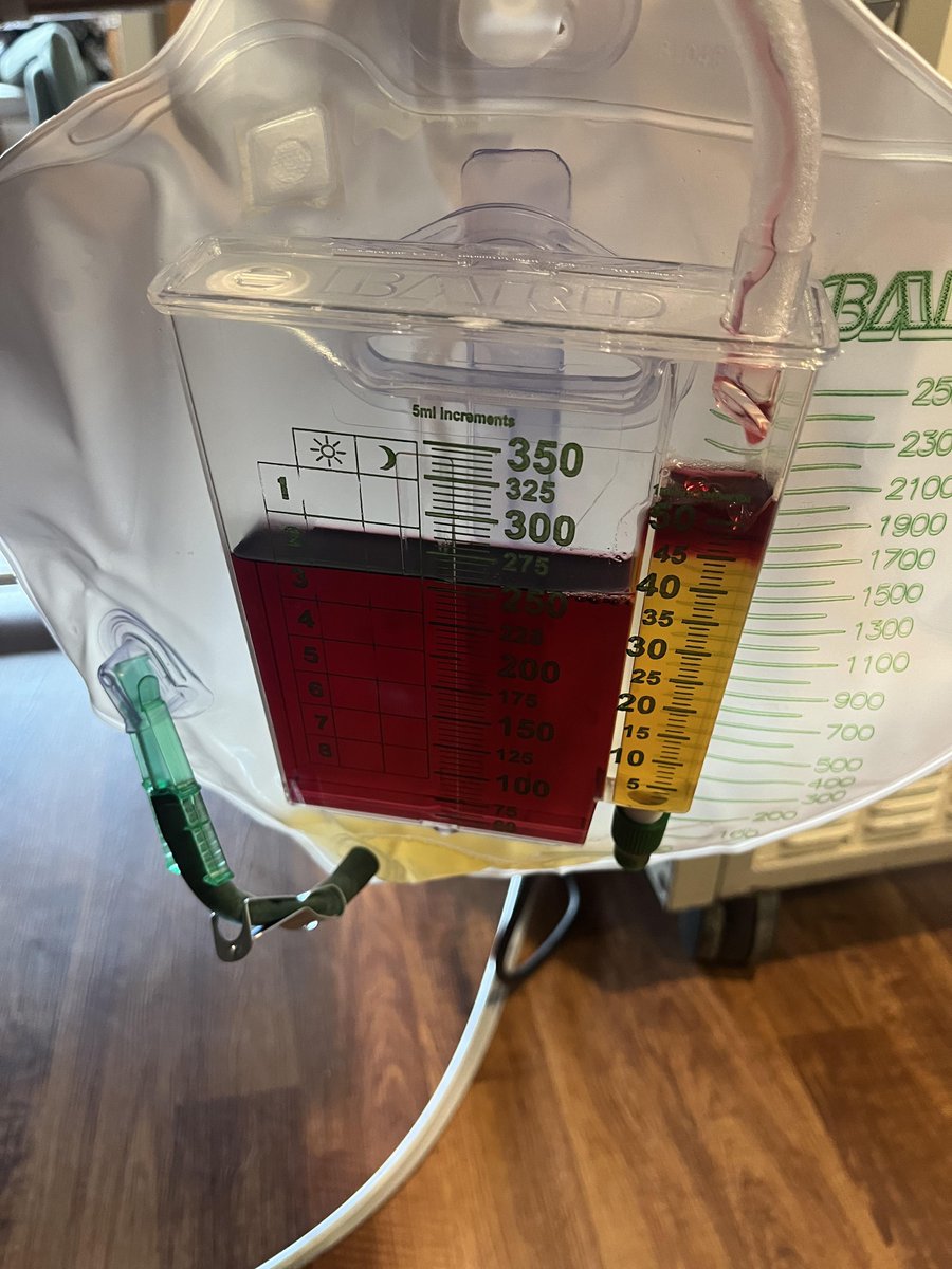 متنوم بسبب حرق مغطي نسبة كبيرة من الجسم 

اللي يعرف ليش لون urine صار كذا فجاه ويربط الامور في بعض خورافي 

عشرين نجمة
⭐️⭐️⭐️⭐️⭐️⭐️⭐️⭐️⭐️⭐️⭐️⭐️⭐️⭐️