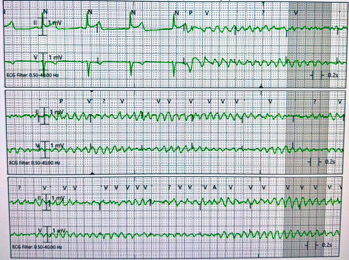 VF arrest on POD#2 after uncomplicated CABG surgery EF 30%. Normal lytes. Resuscitated.

The next best step?
Poll below 👇

#CardioTwitter #Epfellows