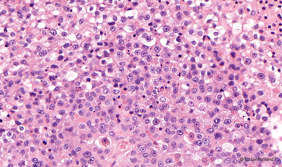 Adult female, reproductive age, omentum.

#BSTpath #Gynpath #GIpath #Pathtwitter #Pathresidents