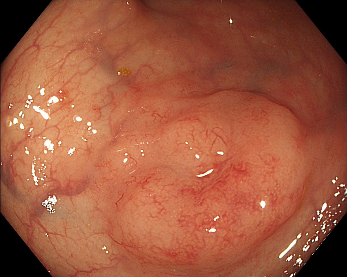 LumirKunovsky's tweet photo. 📢 What is the #diagnosis for this #rectal lesion❓️

2️⃣5️⃣ mm lesion (🗼Paris IIa+IIc)

📮Vote for correct diagnosis in the poll below 👇👇👇

▶️ @stevenbollipo @drkeithsiau @KralJan @CarlKayMD

🟢 @my_ueg 🟢
🔵 @ESGE_news 🔵
🟣 @EndoscopyNow 🟣
⚫️ @OncoAlert ⚫️
🔴 #GITwitter 🔴 https://t.co/1HWObETHtH