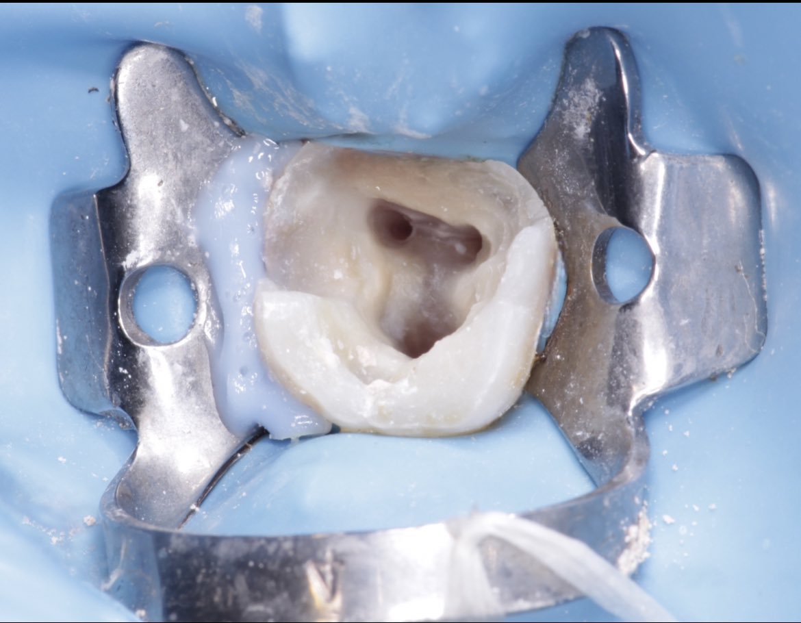 Dr_Yasir9's tweet photo. علاج عصب لضرس سفلي يحتوي على ٣ قنوات عصبية ✨
Endodontic treatment for lower molar https://t.co/pB0oLlEJqV