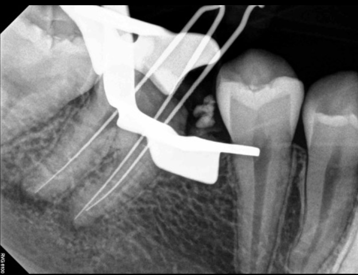 Dr_Yasir9's tweet photo. علاج عصب لضرس سفلي يحتوي على ٣ قنوات عصبية ✨
Endodontic treatment for lower molar https://t.co/pB0oLlEJqV