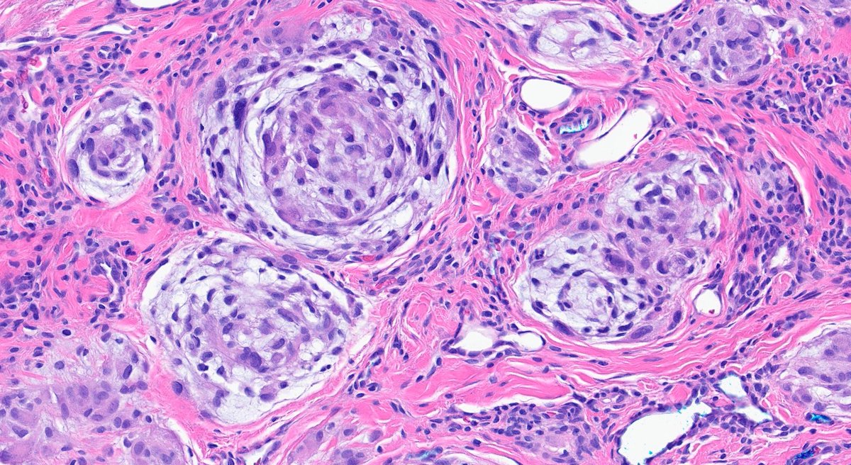 Henry YANG (@henryy_md) on Twitter photo Neurothekeoma. I am still waiting for people to come out of a better name for this "misnomer"😅
25 yo F nose.
#dermpath
<a href="/kis_lorand/">Lorand Kis</a> <a href="/tonitatirado/">Mariantonieta Tirado</a> <a href="/DanGrahamMD/">Dan Graham</a> <a href="/RACARR51/">Richard Carr</a> <a href="/kriyer68/">Kalyani Bambal</a> <a href="/DermpathLove/">DermpathLove</a> <a href="/MarcelaSaebL/">Marcelasaeblima.</a> Neurothekeoma. I am still waiting for people to come out of a better name for this "misnomer"😅
25 yo F nose.
#dermpath
<a href="/kis_lorand/">Lorand Kis</a> <a href="/tonitatirado/">Mariantonieta Tirado</a> <a href="/DanGrahamMD/">Dan Graham</a> <a href="/RACARR51/">Richard Carr</a> <a href="/kriyer68/">Kalyani Bambal</a> <a href="/DermpathLove/">DermpathLove</a> <a href="/MarcelaSaebL/">Marcelasaeblima.</a>