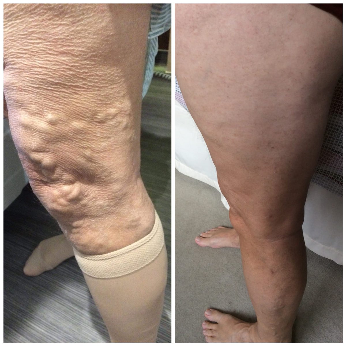 surreyvascular's tweet photo. The #varicosevein clinic you can trust with a proven track record of excellent outcomes.
Call us today 01252 895409 for @spirehealthcare @Candover_Clinic
@ParksideSuite
0118902 8140 for @BerkIndeHosp
#EVLA
#VNUS
#sclerotherapy
@doctifyuk
@TopDoctors_UK
https://t.co/3cZv5WjJs7 https://t.co/cAQdhr2e89