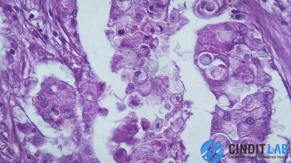 md_castaneda23's tweet photo. El adenocarcinoma pulmonar es un tipo de cáncer de pulmón que se origina en las células glandulares del tejido pulmonar.
El adenocarcinoma pulmonar es una de las formas más comunes de cáncer de pulmón
#cinditlab #pathologylab https://t.co/9VN8NljGj4