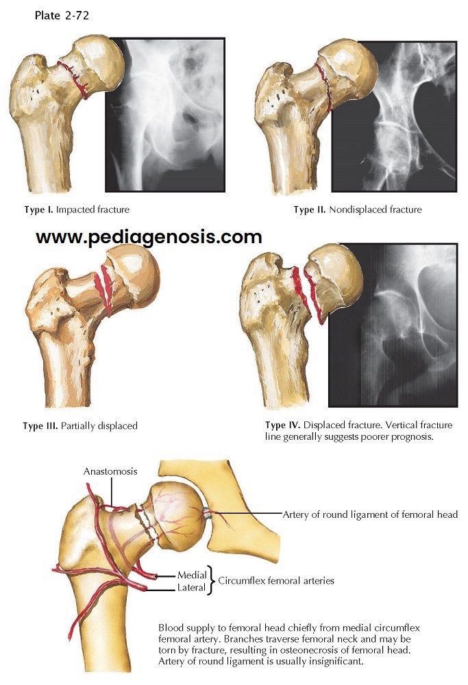 Hip Fractures and X-rays!