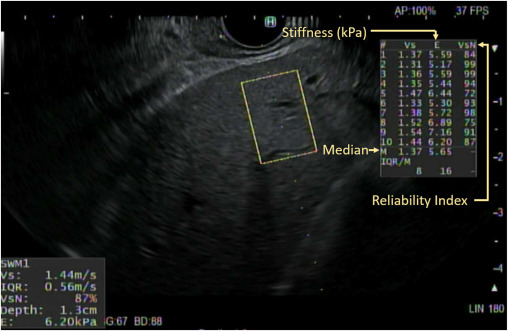 GIE (@gie_journal) on Twitter photo Article in Press: "EUS-guided shear wave elastography for fibrosis screening in patients with obesity and metabolic dysfunction–associated steatotic liver disease: pilot study" by Thomas J. Wang et al. giejournal.org/article/S0016-…
<a href="/ThomasWangMD/">Thomas Wang</a> <a href="/SighPichamol/">Pichamol Jirapinyo, MD, MPH</a> <a href="/Jarshah4/">Raj Shah</a> @metabolicendo Article in Press: "EUS-guided shear wave elastography for fibrosis screening in patients with obesity and metabolic dysfunction–associated steatotic liver disease: pilot study" by Thomas J. Wang et al. giejournal.org/article/S0016-…
<a href="/ThomasWangMD/">Thomas Wang</a> <a href="/SighPichamol/">Pichamol Jirapinyo, MD, MPH</a> <a href="/Jarshah4/">Raj Shah</a> @metabolicendo