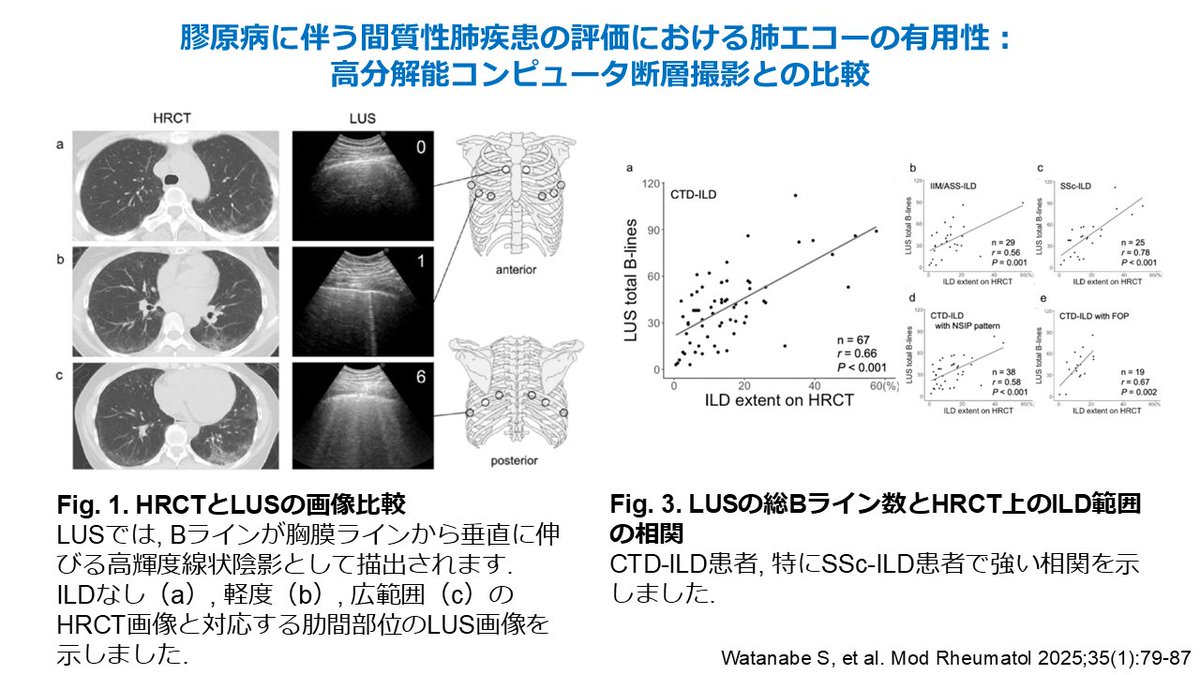 JcrRyumachi's tweet photo. 【Selected Papers 論文紹介】
『膠原病に伴う間質性肺疾患の評価における肺エコーの有用性:高分解能コンピュータ断層撮影との比較』
渡邊 晋二
近年,肺エコー(LUS)は,間質性肺疾患(ILD)の検出において,非侵襲的で簡便かつ容易に利用可能な画像診断ツールとして注目を集めています.一方,膠原病(CTD)の診療においてLUSをどのように実施すべきかは,明らかではありません.本研究では,CTDに伴うILD(CTD-ILD)患者において,LUSの臨床的有用性について高分解能コンピュータ断層撮影(HRCT)と比較を行いました.
本研究では,LUSの単施設前向きデータベースからCTD-ILD患者を対象として選定しました.LUSは14部位を評価し,総Bライン数を検出しました.努力性肺活量,一酸化炭素拡散能(DLco),肺胞換気量あたりのDLco,6分間歩行距離,およびILD-GAPスコアをILDの予後指標としました.
67例の患者が登録され,その内訳は特発性炎症性筋疾患または抗合成酵素症候群が29例,全身性強皮症が25例,関節リウマチが10例,混合性結合組織病が3例でした.CTD-ILD患者において,総Bライン数はHRCT上のILDの範囲と相関しました(r = 0.66, P < 0.001).特にSSc-ILD患者において強い相関を示しました(r = 0.78, P < 0.001).総Bライン数とHRCT上のILD範囲は,予後指標と同程度の相関を示しました.一方,重回帰分析では,予後因子との相関を予測するにあたり,HRCTに加えてLUSを実施することの利点は限定的でした.
本研究の結果から,LUSは,CTD-ILD患者の重症度および予後評価のためのHRCTの代替手段として有用であることが示唆されました.
https://t.co/EagH9ugUjc
#JCR
#日本リウマチ学会
#ModernRheumatology
#SelectedPapers
#論文紹介
