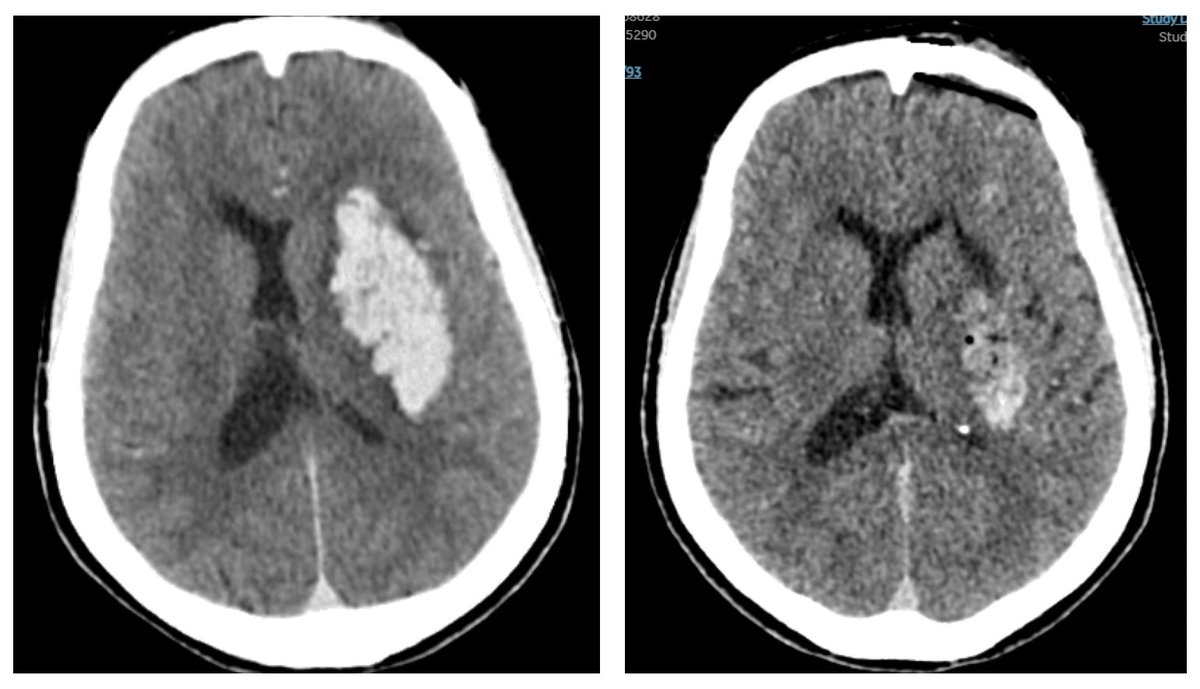 C. J. Jared Chen, MD, FAANS tweet media