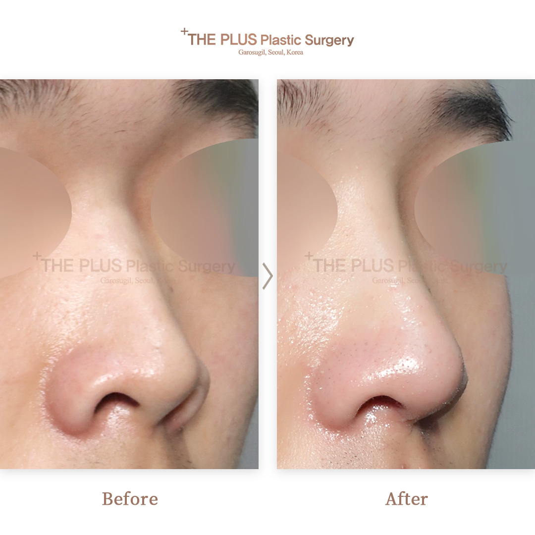 裁断済、書き込みなし】外鼻形成術・鼻中隔矯正術 【公式通販】