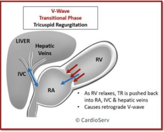 RitikaTuliMD's tweet photo. #CardioNugget 20/365
Severe TR?
Look for hepatic vein systolic flow reversal on Doppler!
Technique:
1. Use subcostal view
2. Sample 2–3 cm from IVC entry 📏
3. Pulsed-wave Doppler (PWD) 🎯
#CardioNuggets #EchoTips #CardioTwitter
https://t.co/0a1K2RGY4X