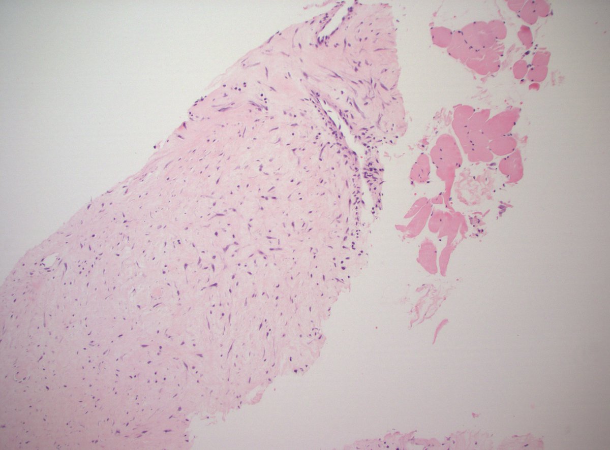 60s F 7.8cm subscapular (inferior tip) mass, with focal rib erosion. Subfascial, possible intramuscular. Dx/IHC? More images below.

#PathTwitter #PathX #BSTpath