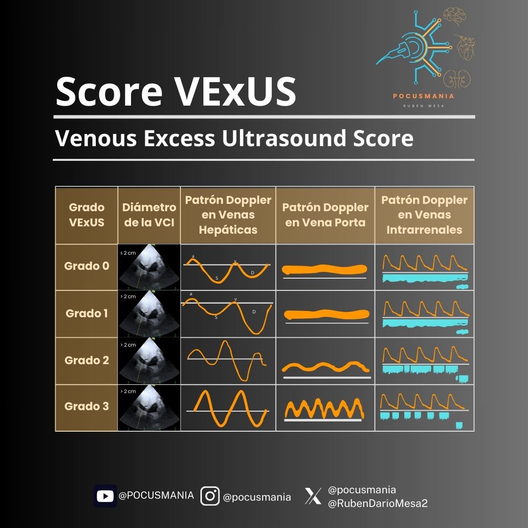 pocusmania's tweet photo. VExUS evalúa congestión venosa sistémica con ecografía Doppler en vena cava, hepática, portal y renal. Clasifica en leve, moderada y severa según flujo y patrones. Herramienta clave en pacientes críticos para manejo de fluidos. #Ultrasonido #VExUS #MedicinaCrítica #POCUS https://t.co/ERFzfrnrMM