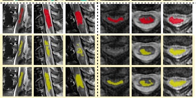 Radiology_AI's tweet photo. #SCIseg accurately segmented intramedullary lesions on a diverse dataset of T2-w MRIs https://t.co/aWdpQeHTEN @naga_karthik7 @PolyNeuro @SpinalToolbox #OpenSource #segmentation #spine https://t.co/yKVwKDBzID