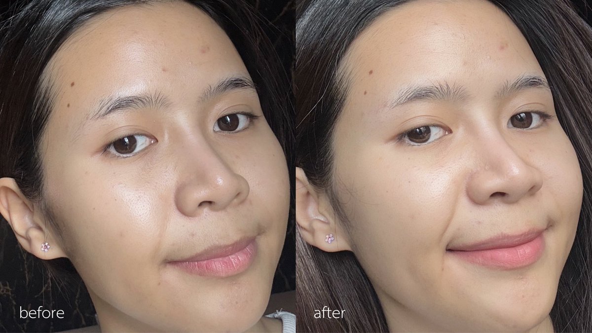 ป้ายยาคู่นี้ไปหลายคนละ บับมันจึ้งเกิน ลาโรชคือที่ 1 ในใจเรื่องสิว ใช้ตั้งแต่เริ่มมีสิวแรกๆ ล่าสุดลองใช้คู่กับเอฟฟาคลาร์เซรั่ม แล้วรู้สึกเห็นผลดีกว่าใช้ตัวเดียวเดี่ยวๆ สิวขึ้นน้อยลง สิวอุดตันคือหลุดออกมาเปงงเม็ด นี่ว่าช่วยเรื่องสิวอักเสบด้วย ของแถมที่ได้เพิ่มคือหน้าใสขึ้นอีก รอยสิวก็จางลง 

#LaRochePosayTH #Effaclar #ลาโรชโพเซย์ #เอฟฟาคลาร์ #เอฟฟาคลาร์ดูโอพลัสเอ็ม