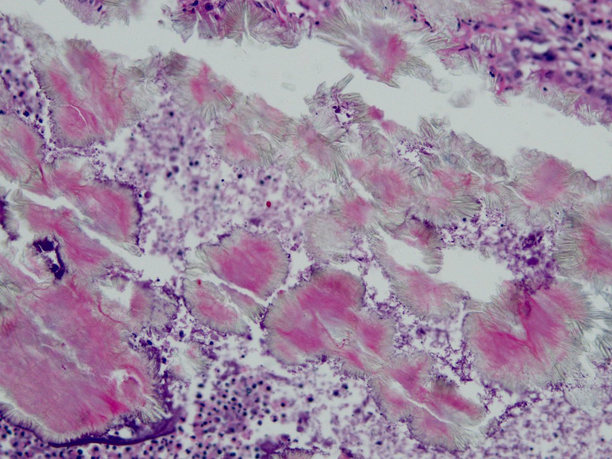 smlungpathguy's tweet image. What is this and what is it a clue to? 

#pathology #pulmpath #pathbugs #crittersontwitter
