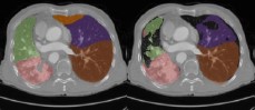 Radiology_AI's tweet photo. Tucker decomposition compression of #TotalSegmentator model reduces computational demand https://t.co/Sd4DqGhUk8 @LMU_Radiology #RadCT #ML #MachineLearning https://t.co/RkXjuzkxAv