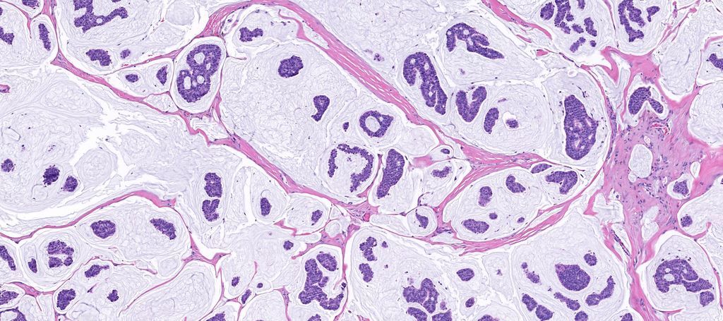 75 yo man w a nodule on the eyebrow. A perfect example of this entity! 
Answer ✅ youtu.be/4C7BDu6Ed-c?si…  
Amazing WSI digital slide: kikoxp.com/posts/3708. 
#Pathology #dermpath #dermatology #dermatologia #dermtwitter