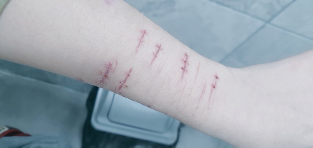 starvnangel's tweet photo. new cvts on my arm 🪡
#sh #shcuts #shtwt #newcuts https://t.co/8OVfg35lCi