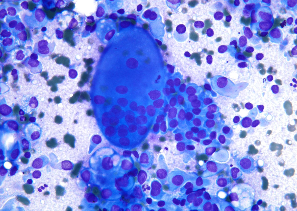 sza_jhcyto's tweet photo. "Multinucleated giant histiocytes" although quite eye-catching, have no real pathologic significance in FNAs of Papillary Thyroid Carcinoma. This one, turned out to be a "tall cell" subtype. https://t.co/i8qKtCSWTo