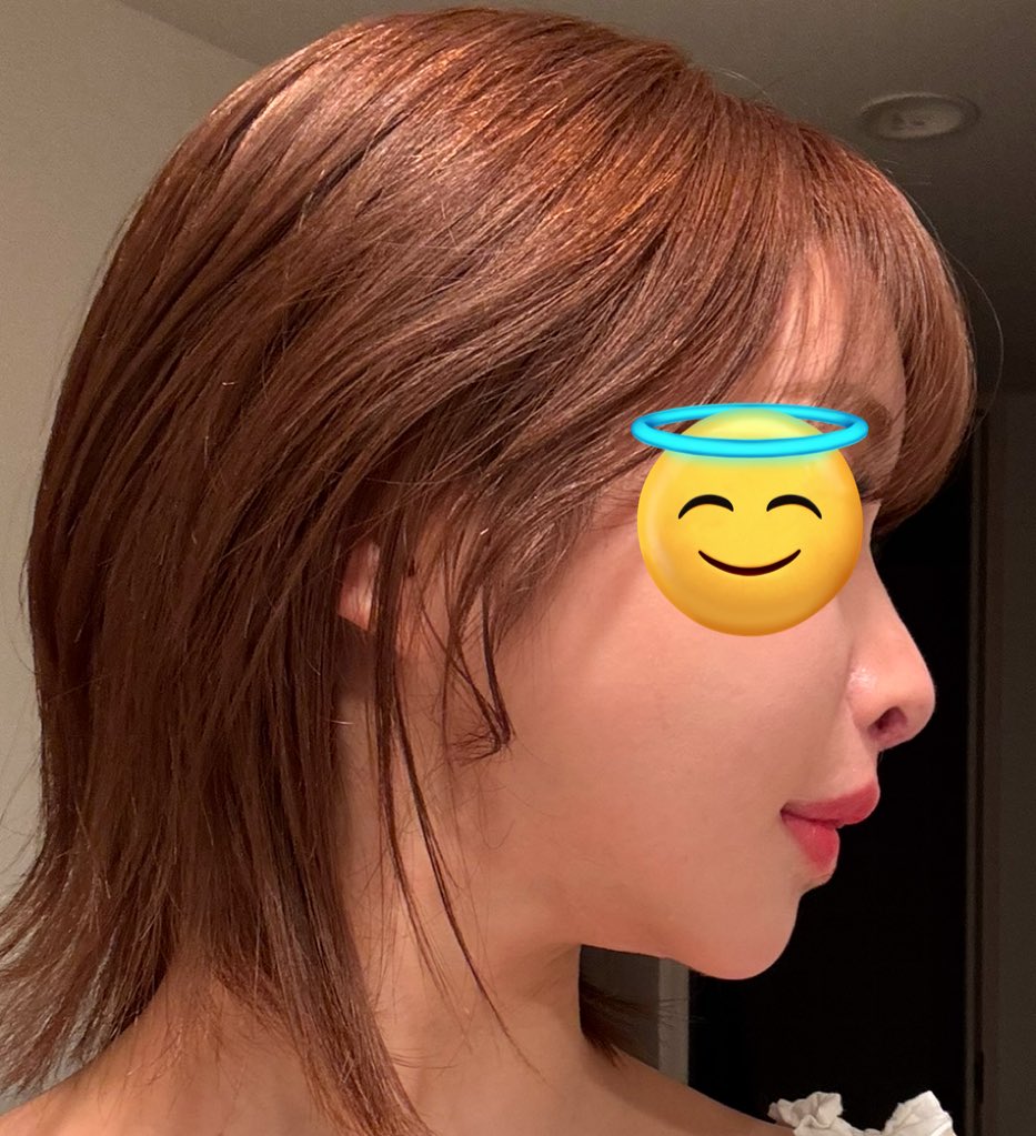 ZdLn73's tweet photo. 1.3枚目before
2.4枚目after
脂肪幹細胞3回、血液幹細胞2回
ポット感🫖と鼻先の凹みかなりマシになったんじゃないかな
脂肪幹細胞がほんとすごい https://t.co/JObP4ZyRoC