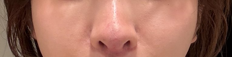 ZdLn73's tweet photo. 1.3枚目before
2.4枚目after
脂肪幹細胞3回、血液幹細胞2回
ポット感🫖と鼻先の凹みかなりマシになったんじゃないかな
脂肪幹細胞がほんとすごい https://t.co/JObP4ZyRoC