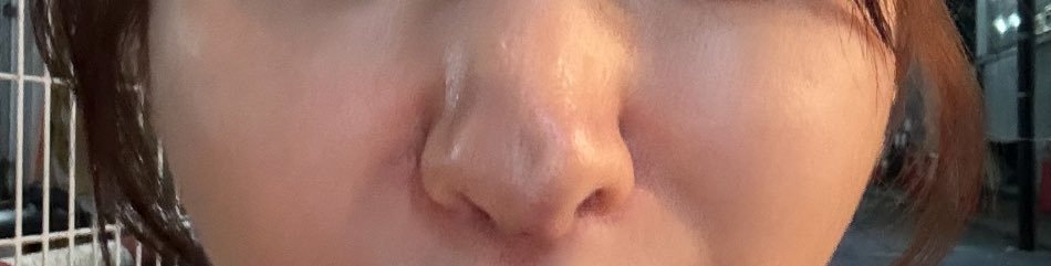 ZdLn73's tweet photo. 1.3枚目before
2.4枚目after
脂肪幹細胞3回、血液幹細胞2回
ポット感🫖と鼻先の凹みかなりマシになったんじゃないかな
脂肪幹細胞がほんとすごい https://t.co/JObP4ZyRoC