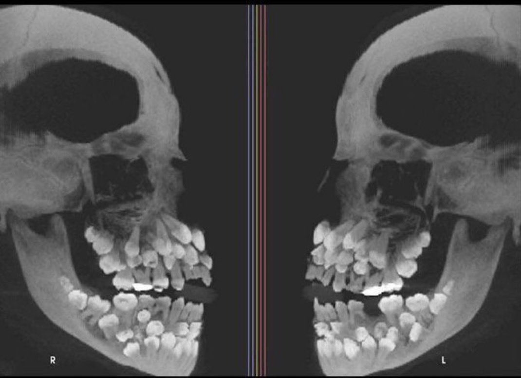 X-ray image showing an extreme case of Hyperdontia.