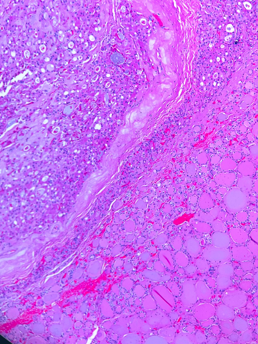 Thyroid follicular lesion 5 MM , do you think it’s invasive or benign? 

#thyroid #glands #Pathology #OralPath #Dermatopathology #Histology #HeadNeck #ENT #endocrine