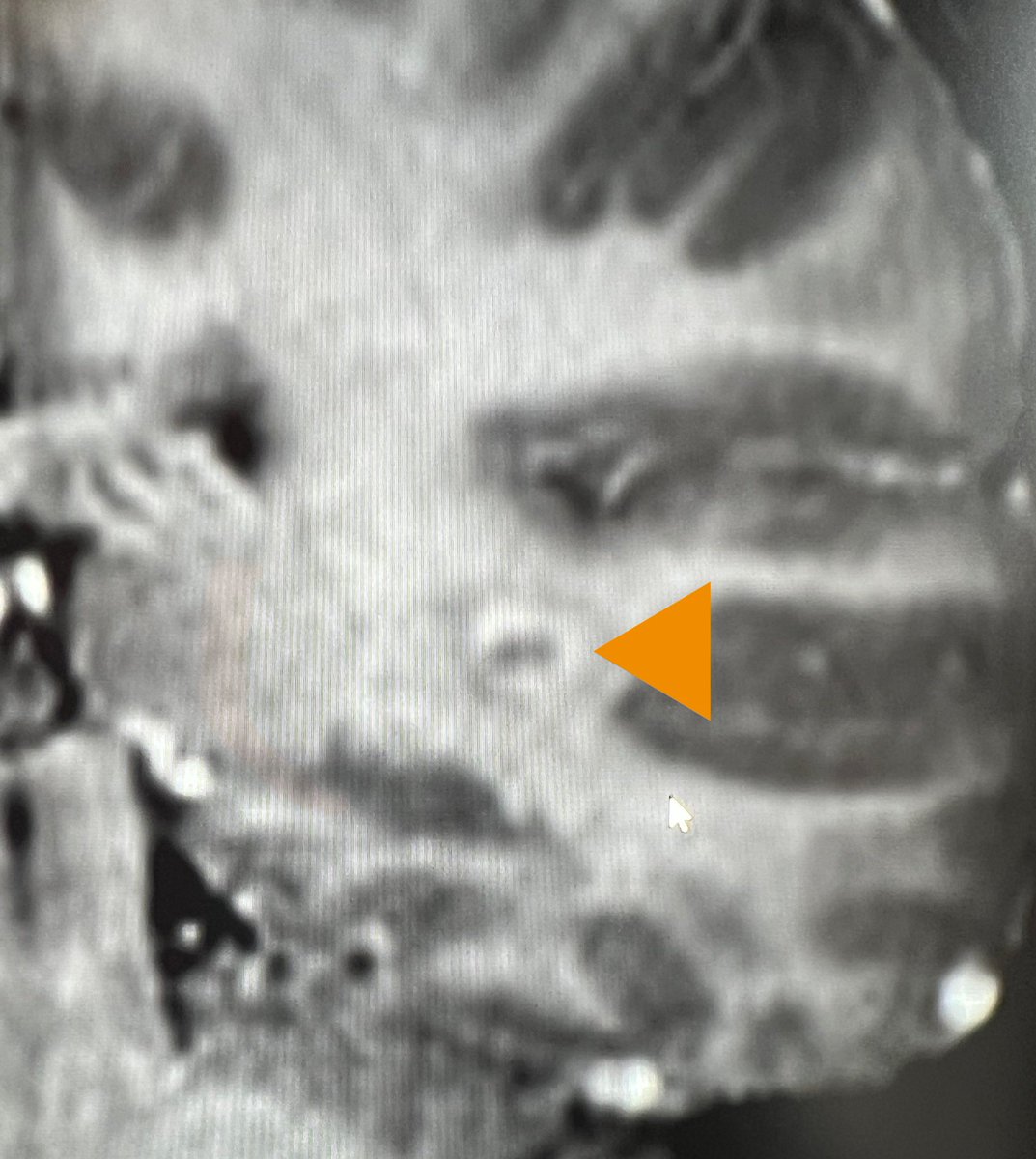 spinacademics's tweet photo. This week’s SPIN-POV here with @drmankad. It may look like multiple sclerosis and satisfy McDonalds criteria for DIT &amp; DIS with that enhancing lesion! Yet it remains a “Radiologically Isolated Syndrome” until the child has a clinical event and or OG bands- both negative here. https://t.co/nWbWnEHeYK