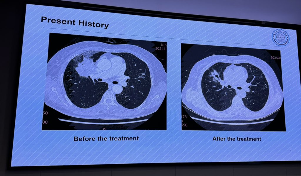 dgonzalezrivas's tweet photo. 2 lung cancer cases today at Suzhou First peoples hospital with the revolutionary single port robotic system SHURUI (right upper lobectomy after chemotherapy, inmunotherapy and target therapy and a simple Right upper lobectomy) https://t.co/Ka2CS3GzqG