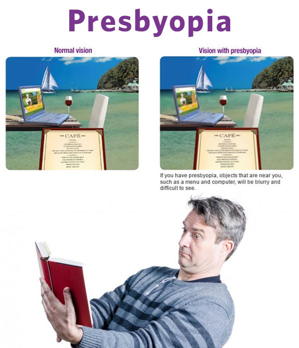Eye_AlRashed's tweet photo. طول النظر الشيخوخي (Presbyopia)

- حالة حتمية (تصيب 100٪ من الاشخاص) مع تقدم العمر

- تبدأ الاعراض غالباً في سن ال 43

- يشتكي الزوار بالعيادة من سوء الرؤية للأشياء القريبة مع أن الرؤية ممتازة للبعيد.

- السبب هو فقدان العدسة داخل العين تدريجياً للقدرة على الانحناء لتغيير قوتها مع تقدم العمر

- الخيارات العلاجية بالنظارات (وهي الأكثر أماناً)، العدسات اللاصقة، قطرات Pilocarpine لتصغير حجم البؤبؤ، استبدال عدسة العين جراحياً (مثل عملية الماء الأبيض) وهو اخر خيار..