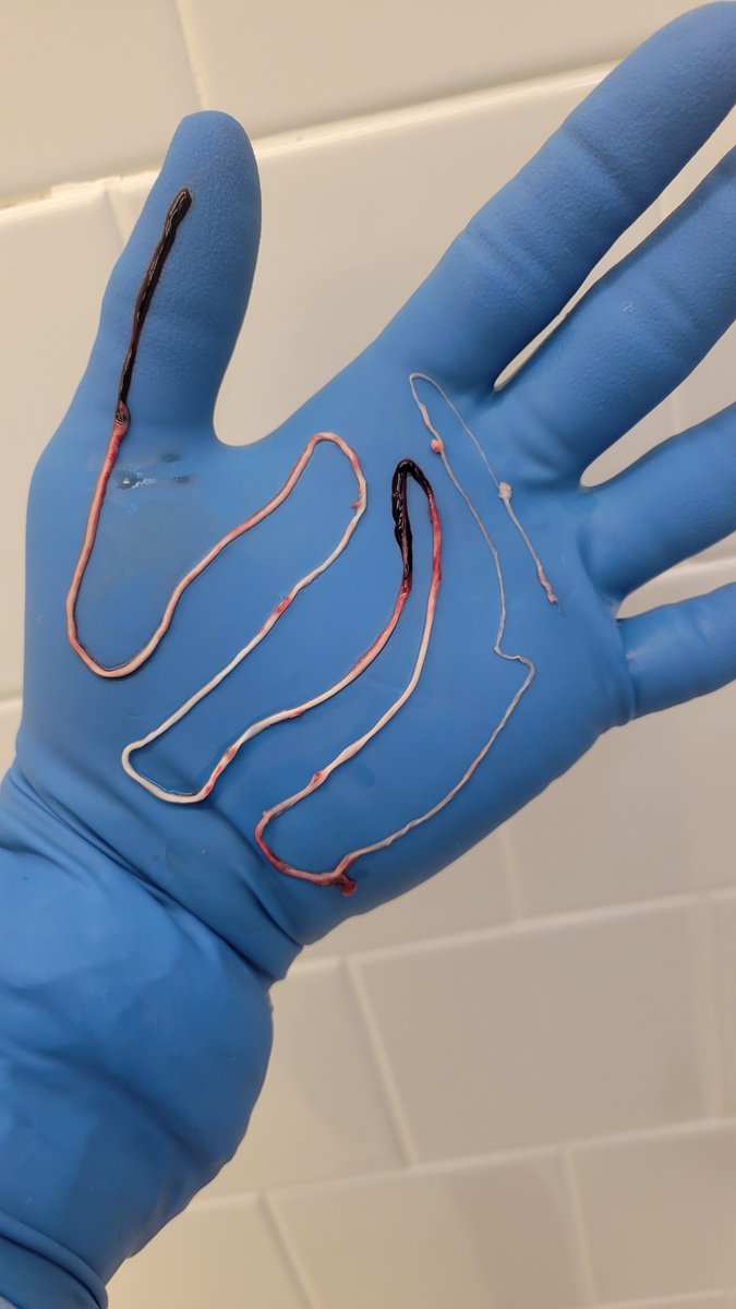 Eventually everyone will know...  😌 

Spike protein is in the virus itself, but the mRNA vaccine is designed to make the body create the spike protein which causes abnormal clotting! 

I only know that in my first 20 years of experience of embalming, I never seen clots like