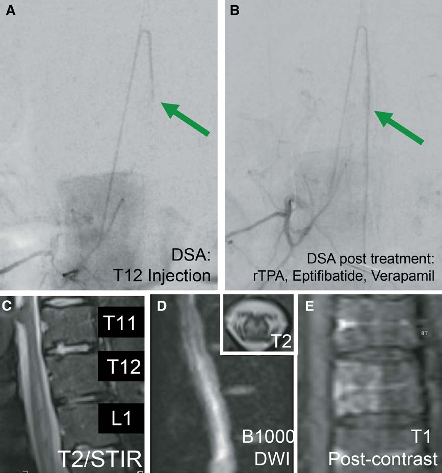 Stroke AHA/ASA (@strokeaha_asa) on Twitter photo #STROKE: Illustrative teaching case demonstrates the key features and management considerations of spinal cord infarction in the young. <a href="/ENossek/">Erez Nossek</a> <a href="/SkellySTL/">Sean Kelly</a> #AHAJournals ahajrnls.org/40acPMk #STROKE: Illustrative teaching case demonstrates the key features and management considerations of spinal cord infarction in the young. <a href="/ENossek/">Erez Nossek</a> <a href="/SkellySTL/">Sean Kelly</a> #AHAJournals ahajrnls.org/40acPMk
