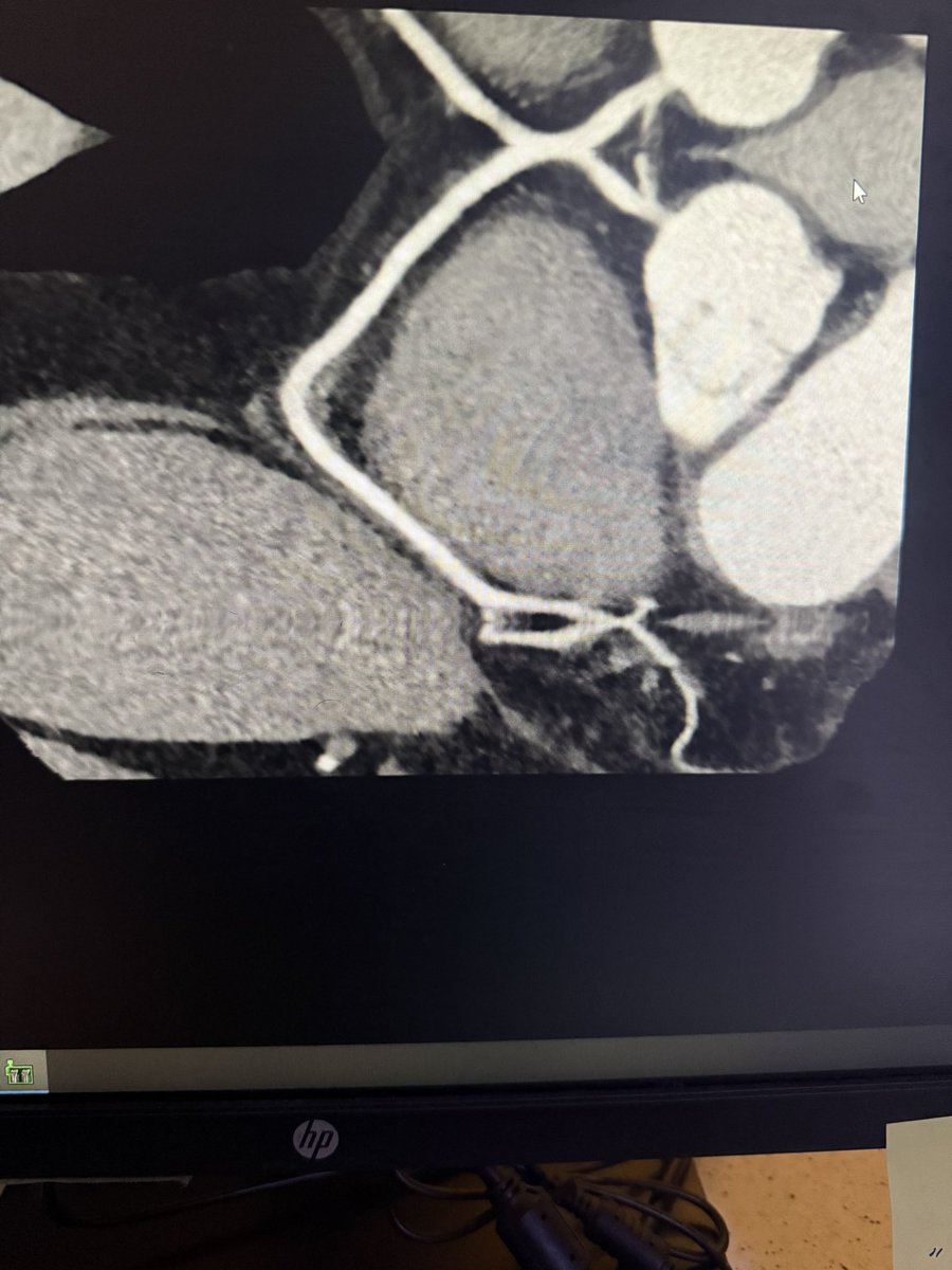 Qx3zo's tweet photo. .
Cardiac CT World 

LAD 

RCA 

With Perfect Timing 😎
. https://t.co/WQrKGC5y8V