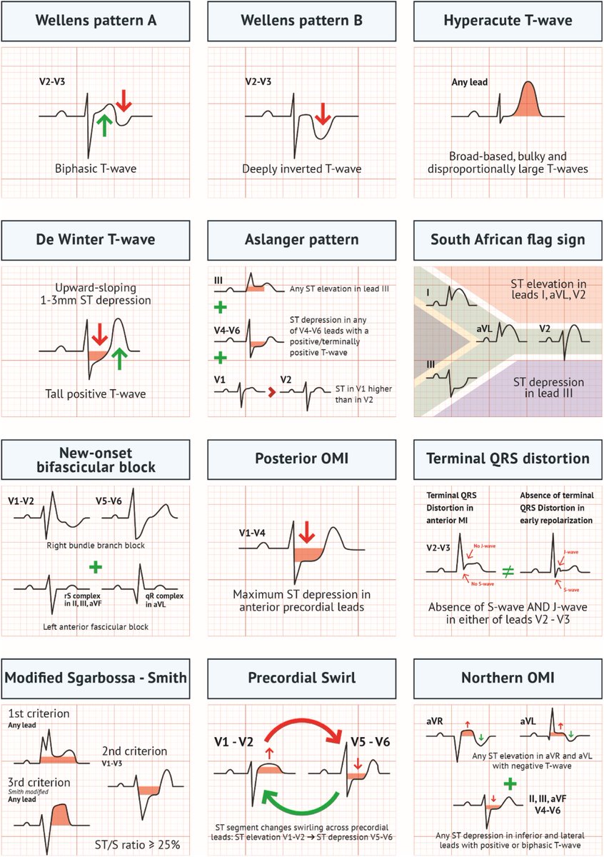 ▶️ ST上昇型心筋梗塞（STEMI）として緊急で対応すべき波形
.
かなりオススメの論文です🔖
.
☑︎ 図がとにかくわかりやすい
☑︎ サプリメントファイルには『12誘導心電図と冠動脈造影のセット』もあり
.
※ 引用元はALT内と次スレ
※ 論文リンクがある著者の先生のpostもこの後引用postしてます🙇