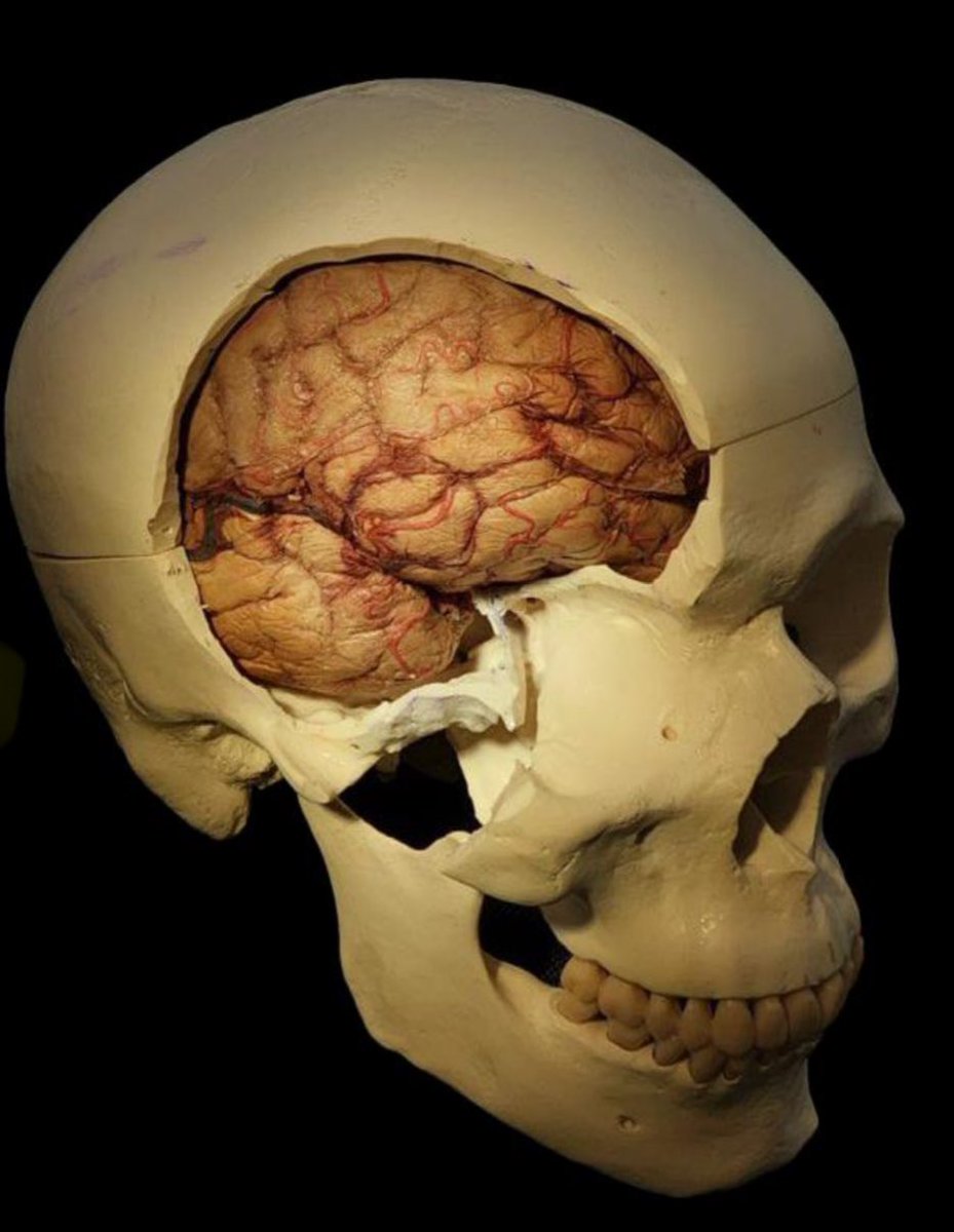 Orbitozygomatic (OZ) craniotomy <a href="/Neuroanatlas/">Neuroan Atlas</a>