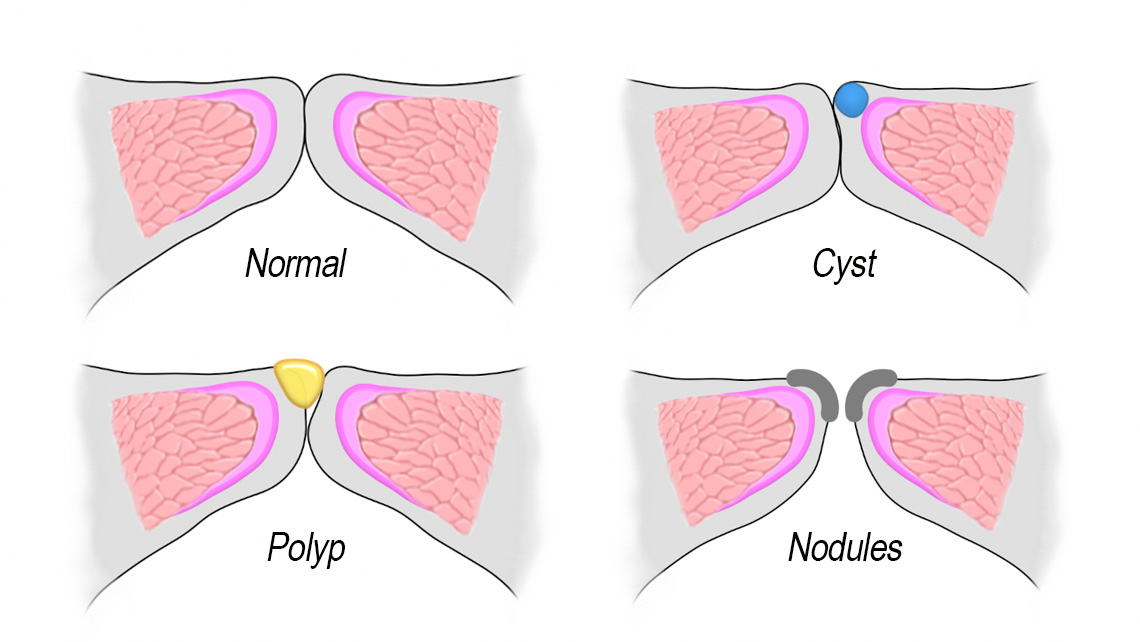 Vocal Fold Vibration (Normal, Nodules, Cyst, Polyp, Muscle Tension Dysphonia, Bowed/Paralysis) youtu.be/mQryxnJC0Eo