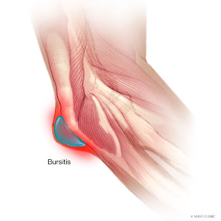 mayoclinicortho's tweet image. #DYK that your elbow has a built-in cushion?

The #elbow (olecranon) bursa is a thin sac of fluid that protects this sensitive joint from trauma. When inflamed this can cause pain and swelling.

Learn about at-home treatment options from our experts: mayocl.in/4hbfmwG