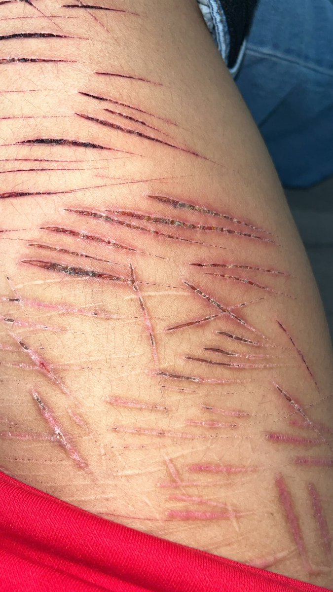 Ticcitoby__irl's tweet photo. ts hurts so bad im praying its just cause its bruised and not infected #shtwt #babybeans #deepstyros #slittwt https://t.co/OMu6a6QYYN