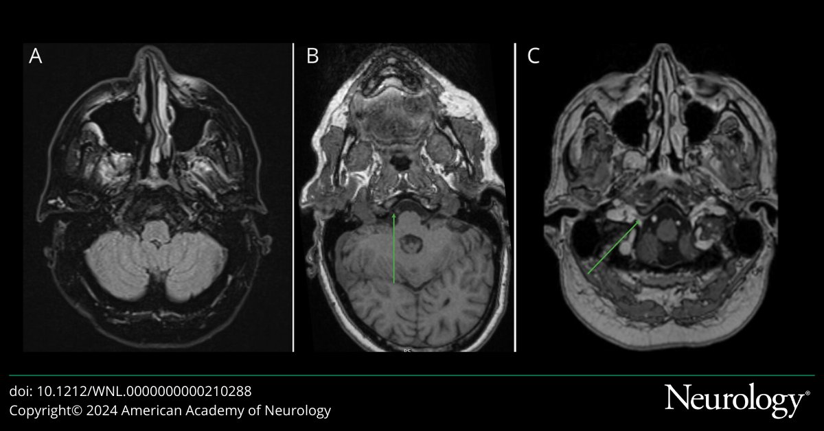 Irregular and reversible tongue atrophy can occur in anti-AChR antibody–positive myasthenia gravis, although the exact pathophysiologic mechanism remains unclear. Learn more in this #NeuroImage article: hubs.la/Q032WKYB0