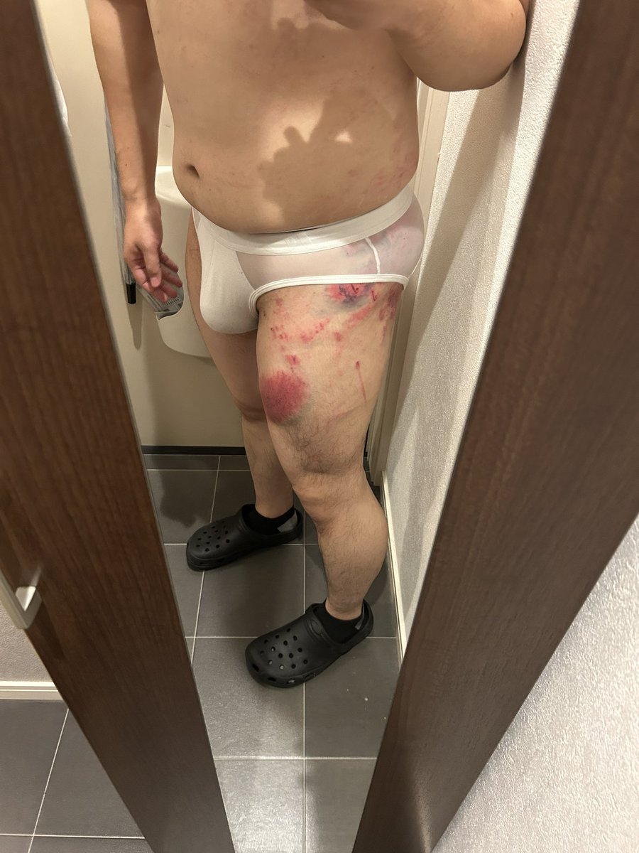 chastitforeskin's tweet photo. 閲覧注意と言っておきながらセンシティブ設定してなかったので再喝

ムチ痕凄いことになっちゃった
⚠️閲覧注意⚠️ https://t.co/RQfSseT8b4